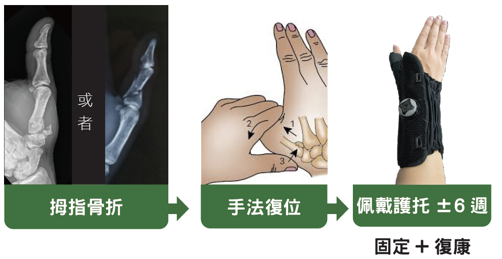 Saddle joint conservative treatment 1